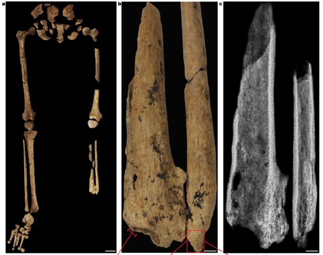 bukti-amputasi-tertua-ditemukan,-terjadi-31.000-tahun-silam